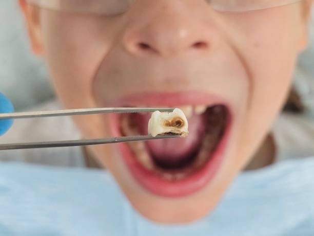 Best Emergency Tooth Extraction in Lake Stevens, WA